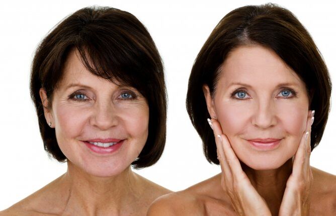 Before and after RF raised