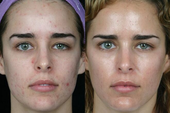 Before and after laser grinding the skin of the face