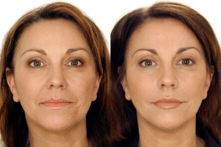 Before and after massage of the face lpg