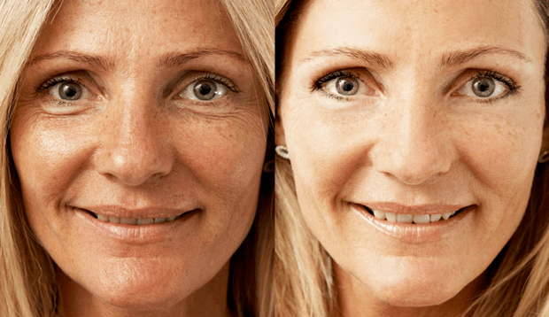 Elos before and after