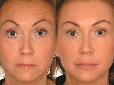 Micro -current before and after treatment before and after treatment
